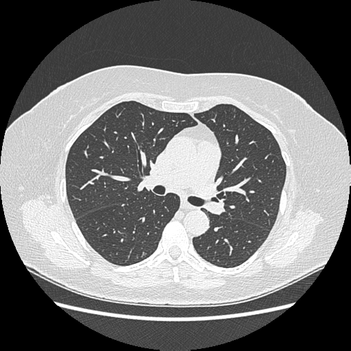 Adenocarcinoma in situ of lung (Radiopaedia 38685-40829 B 100).png