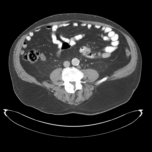 Adenocarcioma of rectum- T1 lesion (Radiopaedia 36921-38547 Axial C+ portal venous phase 53).png