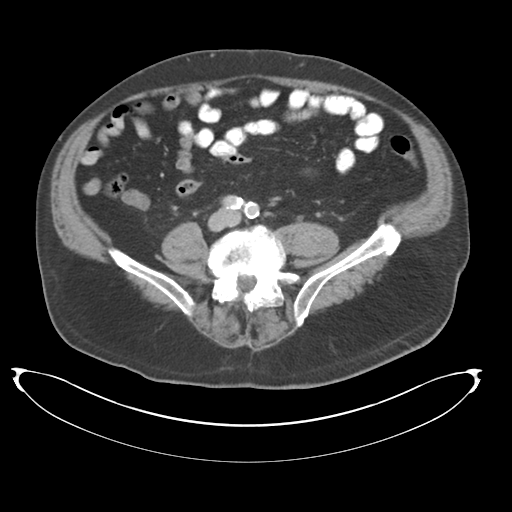 Adenocarcioma of rectum- T1 lesion (Radiopaedia 36921-38547 Axial C+ portal venous phase 58).png