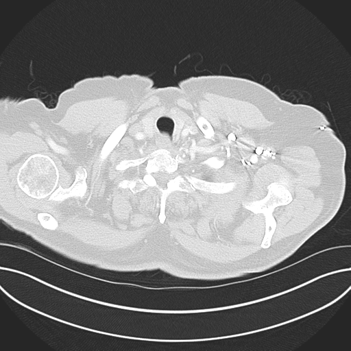 Adenocarcioma of rectum- T1 lesion (Radiopaedia 36921-38547 Axial lung window 6).png