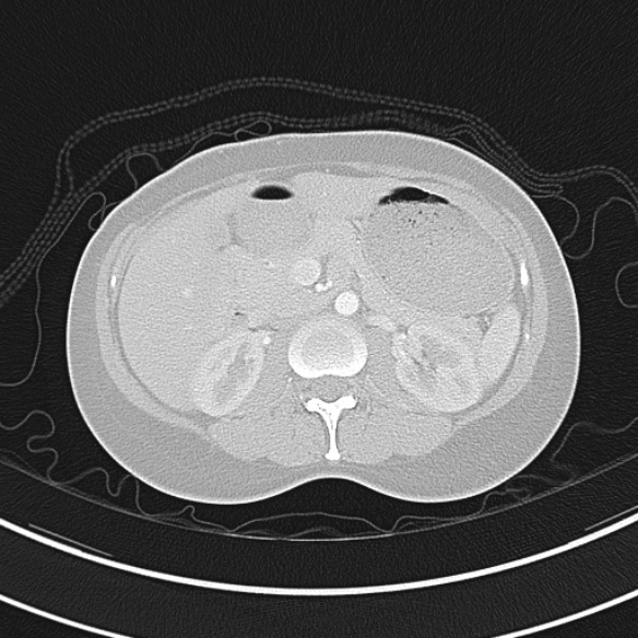Adenocystic carcinoma of the trachea (Radiopaedia 47677-52525 Axial lung window 86).jpg