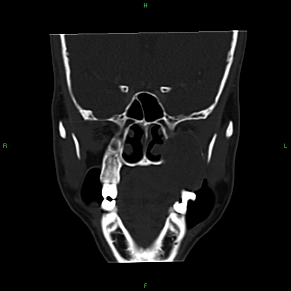 File:Adenoid cystic carcinoma of hard palate (Radiopaedia 26137-26273 Coronal bone window 13).jpg