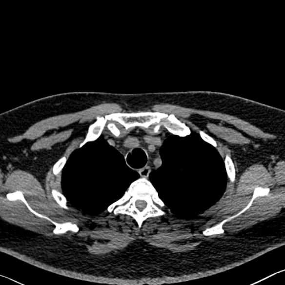 Adenoid cystic carcinoma of the trachea (Radiopaedia 49042-54137 Axial non-contrast 61).jpg