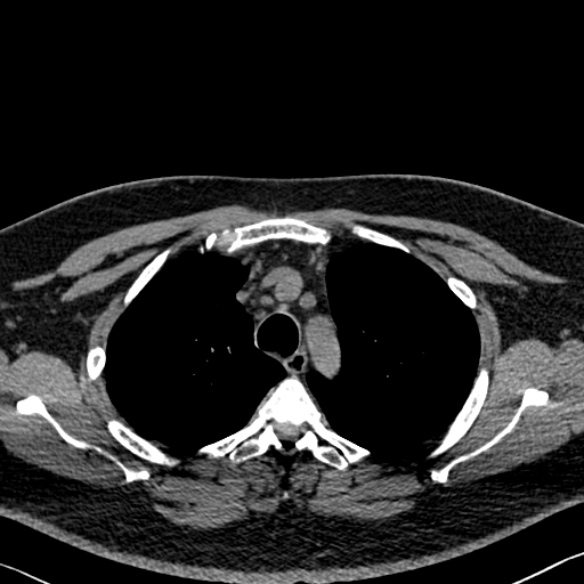 Adenoid cystic carcinoma of the trachea (Radiopaedia 49042-54137 Axial non-contrast 82).jpg
