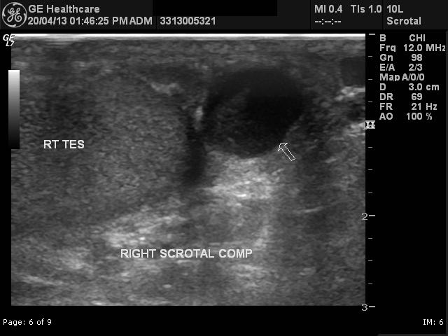 File:Adenomatoid tumor of the scrotum (Radiopaedia 22739-22762 A 1).jpg