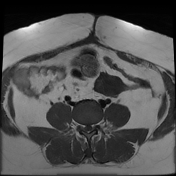 File:Adenomyosis within a didelphys uterus (Radiopaedia 70175-80215 Axial T1 11).jpg