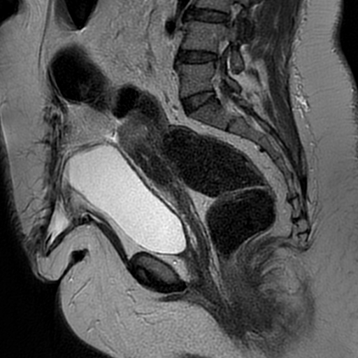 File:Adenomyosis within a didelphys uterus (Radiopaedia 70175-80215 Sagittal T2 17).jpg