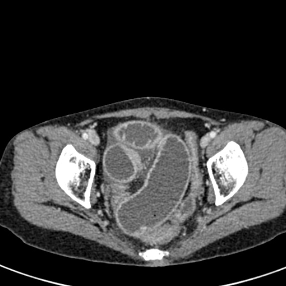 File:Adhesional small bowel obstruction (Radiopaedia 48397-53305 Axial C+ portal venous phase 83).jpg