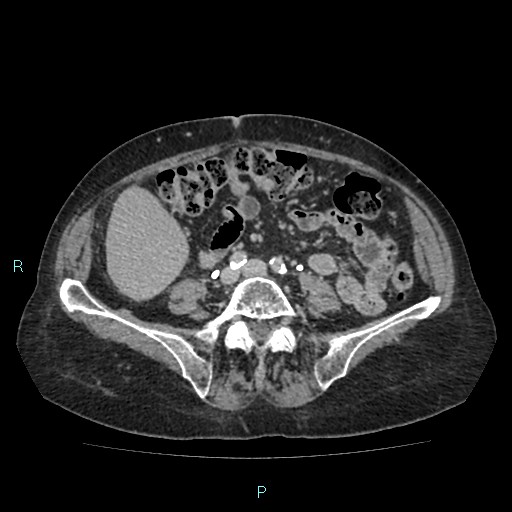 File:Adrenal collision tumor (ACT) (Radiopaedia 48462-53379 Axial C+ delayed 42).jpg