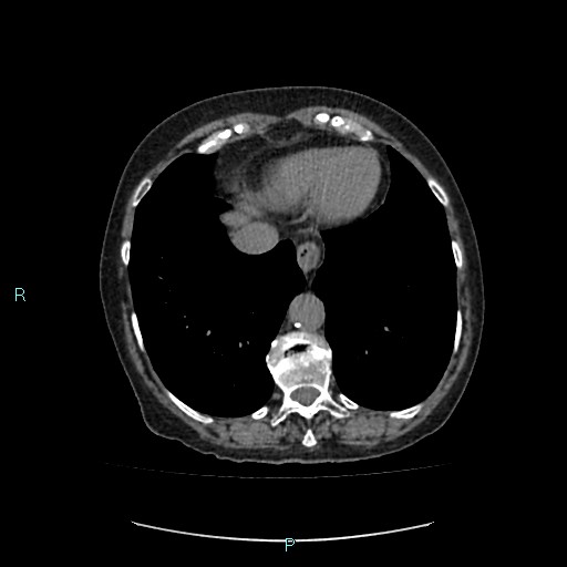 File:Adrenal collision tumor (ACT) (Radiopaedia 48462-53379 Axial non-contrast 4).jpg