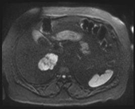 File:Adrenal cortical carcinoma (Radiopaedia 64017-72770 Axial DWI 99).jpg