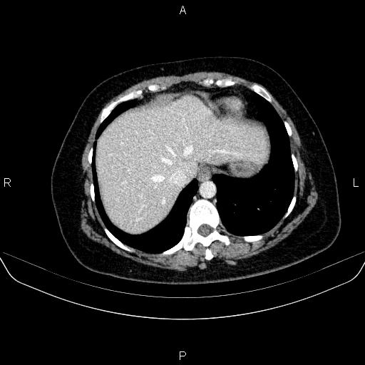 Adrenal cortical carcinoma (Radiopaedia 84882-100379 Axial C+ portal venous phase 11).jpg
