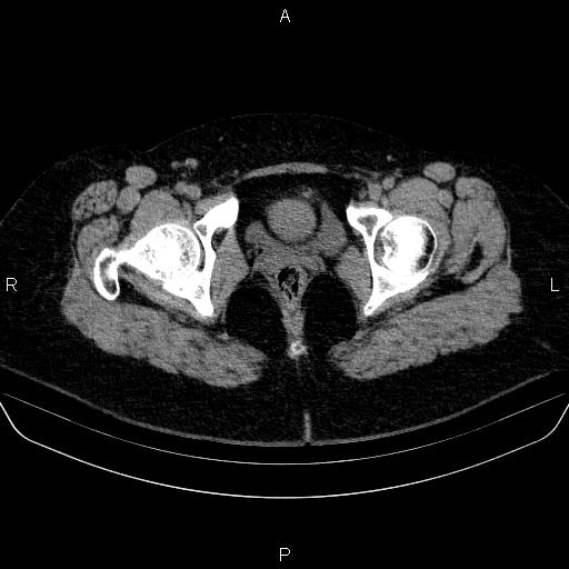File:Adrenal cortical carcinoma (Radiopaedia 84882-100379 Axial non-contrast 94).jpg