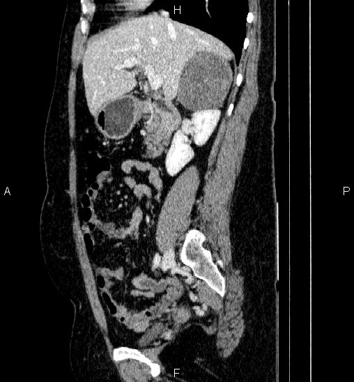 File:Adrenal cortical carcinoma (Radiopaedia 84882-100379 Sagittal C+ portal venous phase 34).jpg