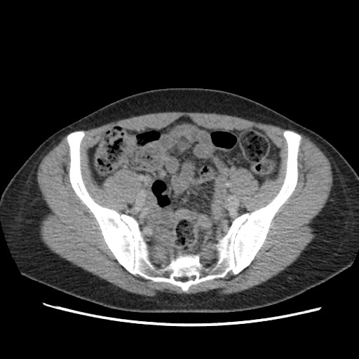 Adrenal cyst (Radiopaedia 64869-73813 Axial C+ portal venous phase 61).jpg