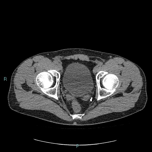 Adrenal cystic lymphangioma (Radiopaedia 83161-97534 Axial non-contrast 92).jpg