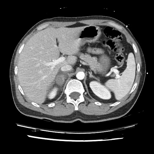 Adrenal gland trauma (Radiopaedia 81351-95078 Axial Dual bolus trauma C+ 62).jpg