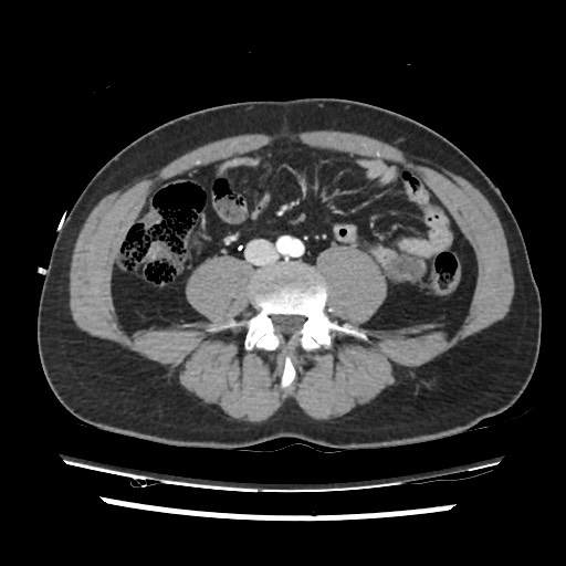 File:Adrenal gland trauma (Radiopaedia 81351-95078 Axial Dual bolus trauma C+ 88).jpg