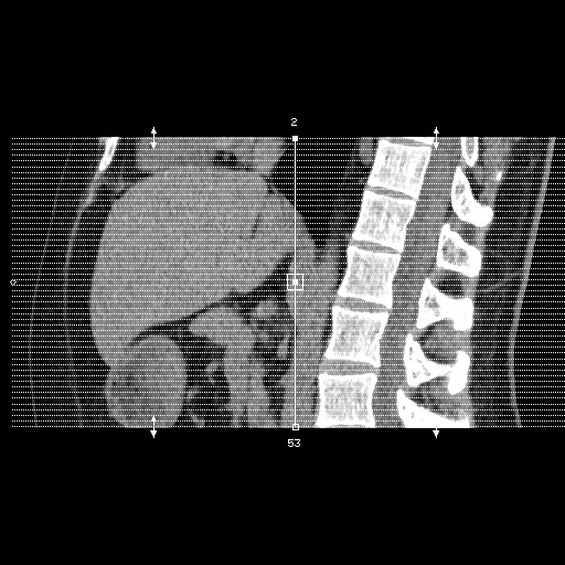 Adrenal gland trauma (Radiopaedia 81351-95079 Axial non-contrast 1).jpg