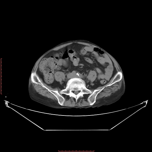 File:Adrenal hemangioma (Radiopaedia 68923-78668 Axial non-contrast 49).jpg
