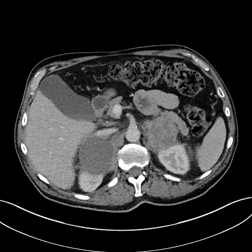 Adrenal lymphoma (Radiopaedia 73730-84529 Axial C+ portal venous phase 34).jpg