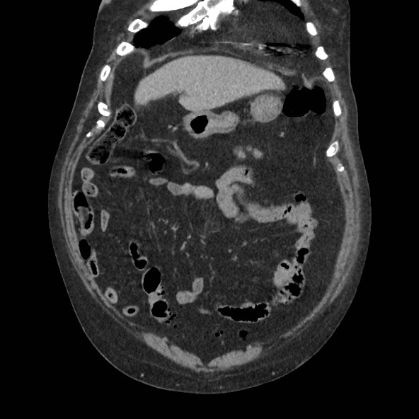Adrenal lymphoma (Radiopaedia 84145-99415 Coronal C+ portal venous phase 18).jpg