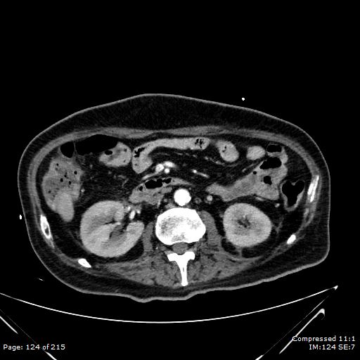 Adrenal metastasis (Radiopaedia 78425-91079 Axial C+ arterial phase 54).jpg