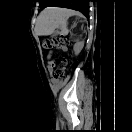 File:Adrenal myelolipoma (Radiopaedia 41843-44834 Sagittal non-contrast 6).jpg