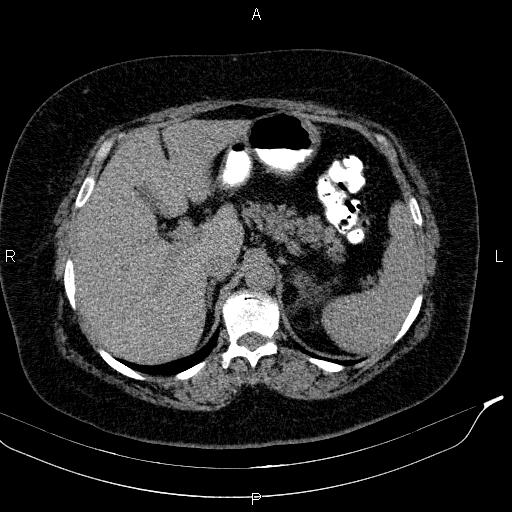 Adrenal myelolipoma (Radiopaedia 84319-99617 Axial With oral contrast 58).jpg