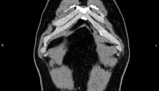 Adrenal myelolipoma (Radiopaedia 84321-99619 Coronal non-contrast 3).jpg