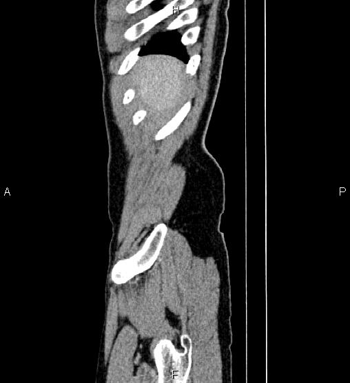 Adrenal myelolipoma (Radiopaedia 87794-104246 Sagittal renal cortical phase 4).jpg