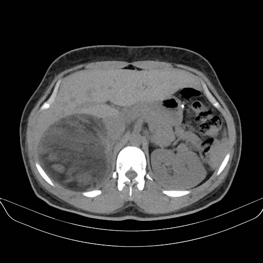 Adrenal myelolipoma - bilateral (Radiopaedia 74805-85810 Axial non-contrast 22).jpg