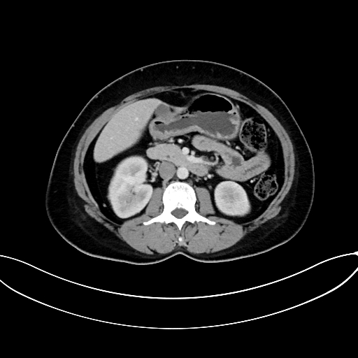 Adrenocortical carcinoma (Radiopaedia 87281-103569 Axial C+ portal venous phase 40).jpg