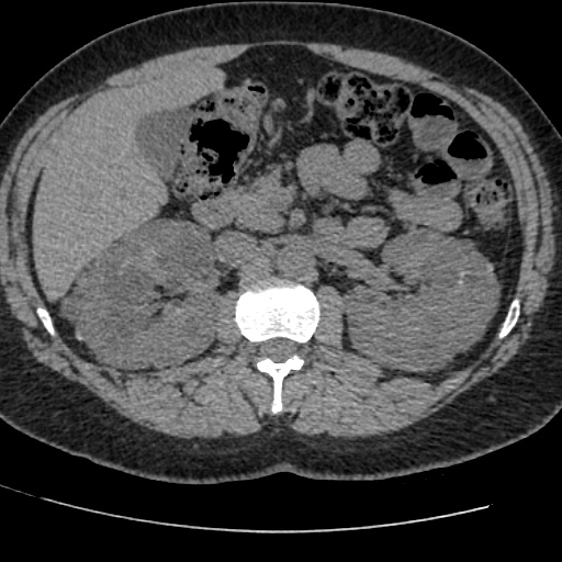 Adult polycystic kidney disease (Radiopaedia 59075-66368 Axial non-contrast 27).jpg