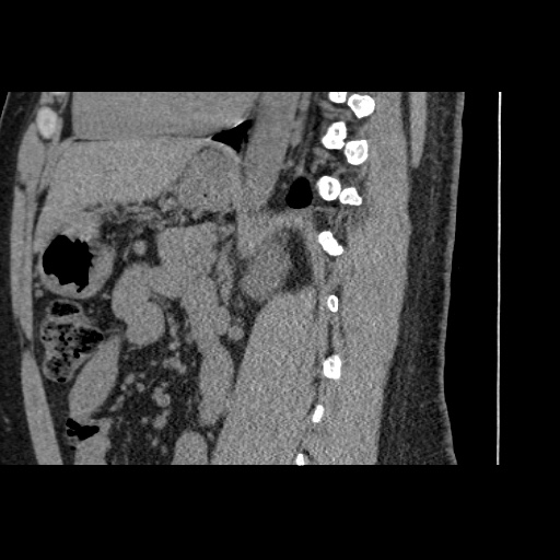 Adult polycystic kidney disease (Radiopaedia 59075-66368 Sagittal non-contrast 52).jpg