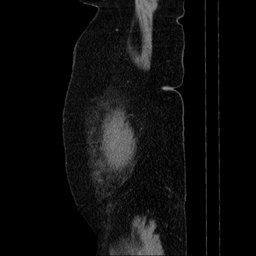 File:Afferent loop syndrome - secondary to incarcerated trocar site hernia (Radiopaedia 82959-97305 Sagittal C+ portal venous phase 151).jpg