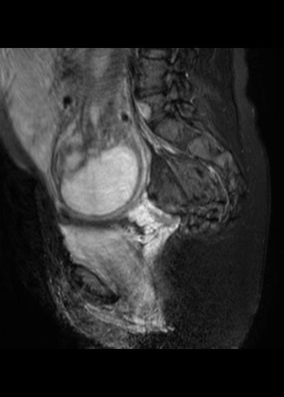File:Aggressive angiomyxoma of the pelvis and perineum (Radiopaedia 59162-66479 Sagittal T2 fat sat 10).jpg