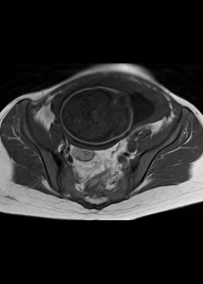 File:Aggressive angiomyxoma of the pelvis and perineum (Radiopaedia 59162-66479 T1 20).jpg