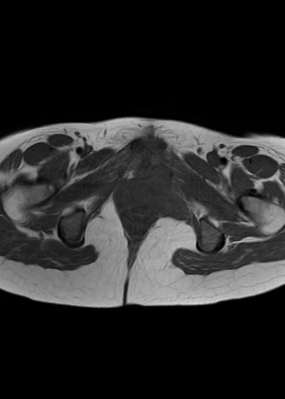 File:Aggressive angiomyxoma of the pelvis and perineum (Radiopaedia 59162-66479 T1 6).jpg