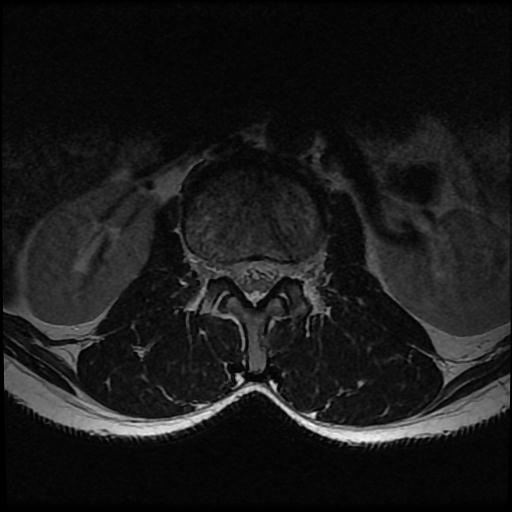 File:Aggressive vertebral hemangioma with pathological fracture (Radiopaedia 69528-79411 Axial T2 12).jpg