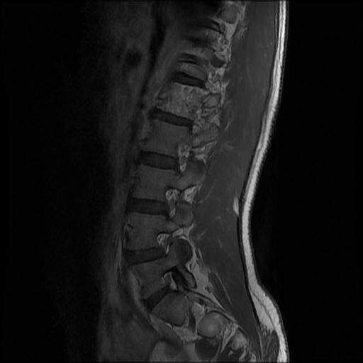 File:Aggressive vertebral hemangioma with pathological fracture (Radiopaedia 69528-79411 Sagittal T1 C+ 1).jpg