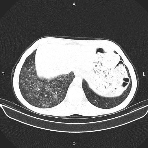 Air bronchogram in pneumonia (Radiopaedia 85719-101512 Axial lung window 58).jpg