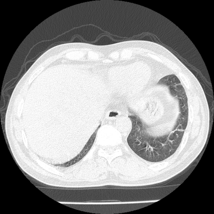 Airway foreign body in adult (Radiopaedia 85907-101779 Axial lung window 159).jpg