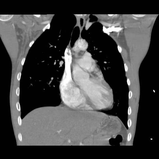 File:Alagille syndrome with pulmonary hypertension (Radiopaedia 49384-54980 C 3).jpg