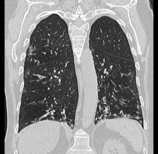 Alpha-1-antitrypsin deficiency (Radiopaedia 72058-82557 Coronal lung window 68).jpg
