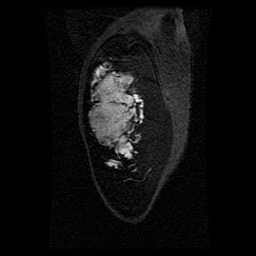 Alveolar soft part sarcoma (Radiopaedia 64501-73678 D 116).jpg