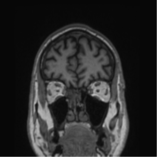 Alzheimer's disease- with Gerstmann syndrome and dressing apraxia (Radiopaedia 54882-61150 Coronal T1 75).png