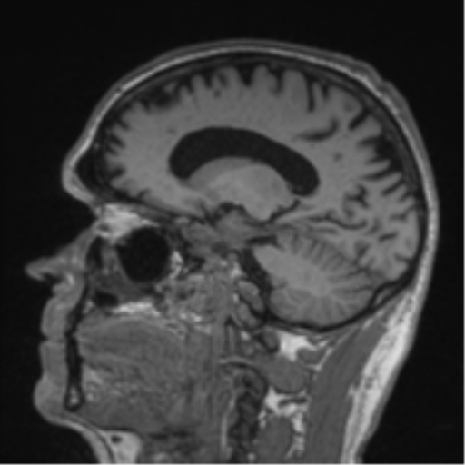 Alzheimer's disease- with Gerstmann syndrome and dressing apraxia (Radiopaedia 54882-61150 Sagittal T1 27).png