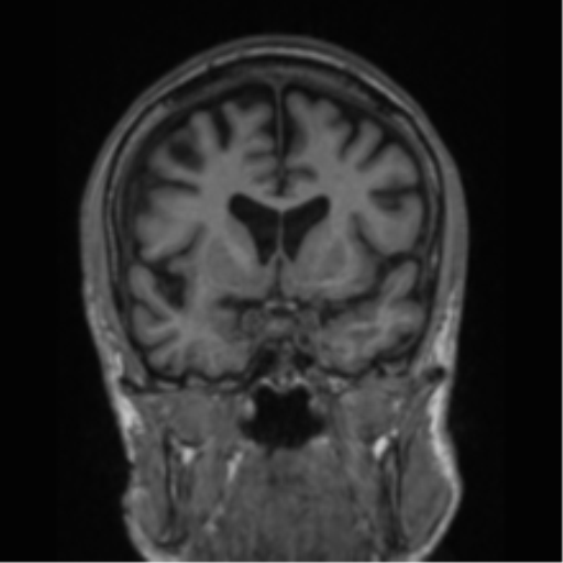 File:Alzheimer's disease- with apraxia (Radiopaedia 54763-61011 Coronal T1 60).png