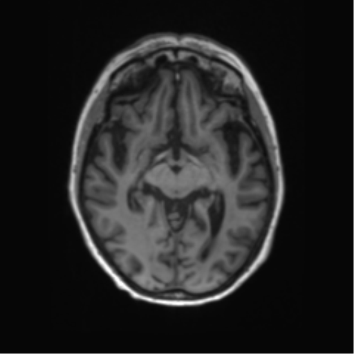 File:Alzheimer's disease (Radiopaedia 42658-45802 Axial T1 89).png